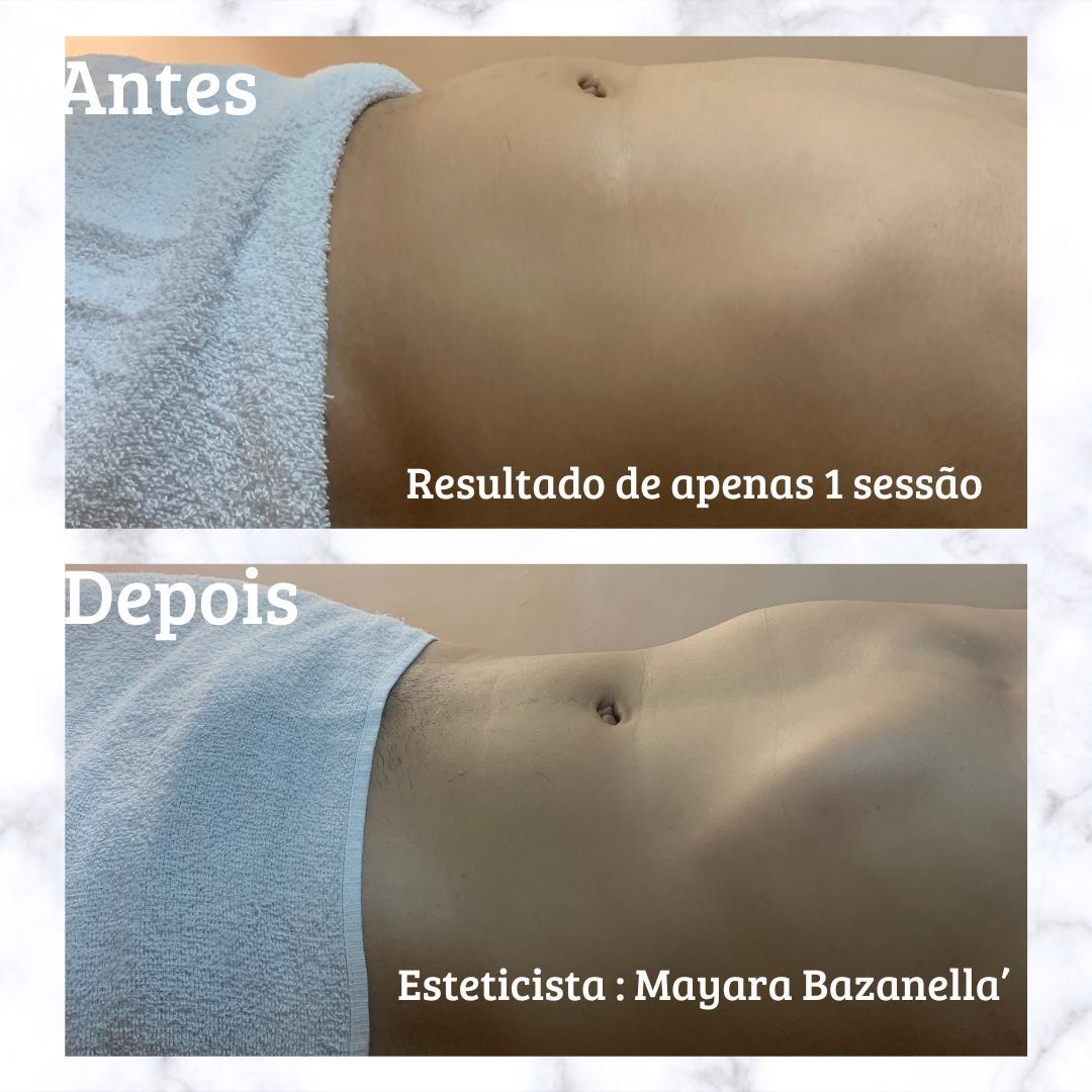 Antes e depois massagem modeladora turbinada — 1 sessão Cascavel