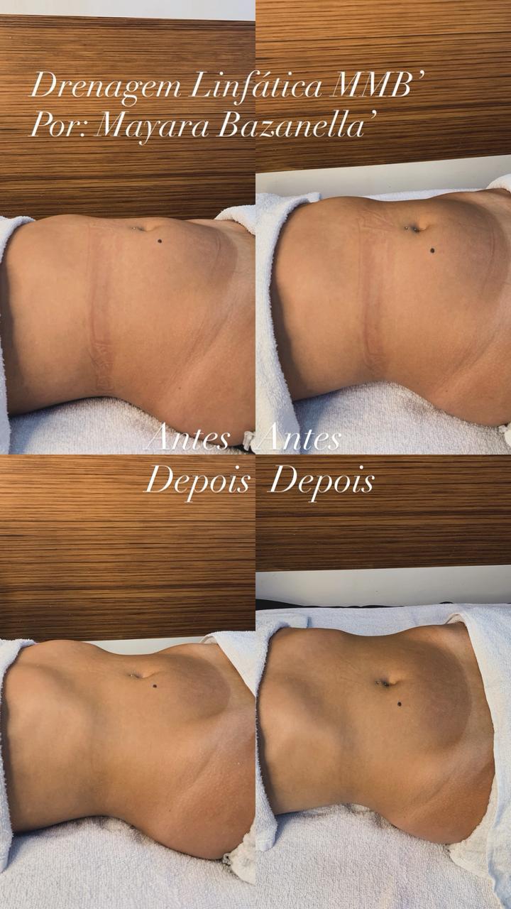 Antes e depois drenagem linfática MMB por Mayara Bazanella